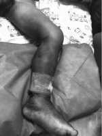 入院时孩子左腿呈黑紫色、肿胀 院方供图 - 新浪吉林