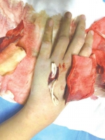 长春13岁男孩买条“竹叶青”被咬伤 住了7天ICU才脱离生命危险 - 新浪吉林